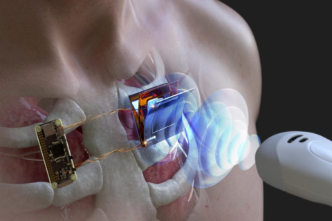 В Корее разработана технология использования ультразвуковых волн для зарядки имплантированных в тело электронных устройств